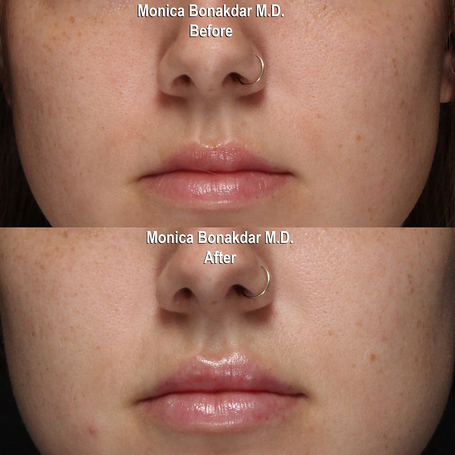 Before and after skin treatment comparison.